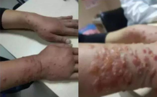 隐翅虫咬人后症状,别在听信谣传了