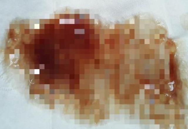 血精什么病男人血精到底是什么病
