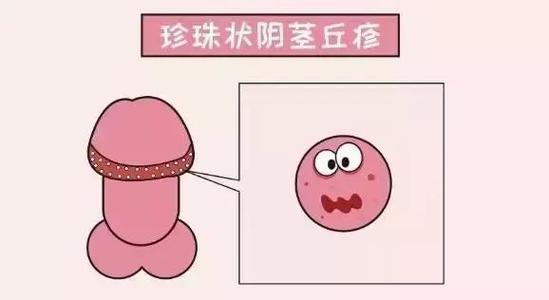 扩展资料 冠状沟部位的保健工作应该注重,因为其实这些部位也很容