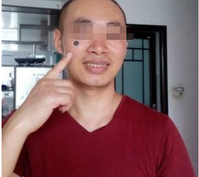 痦子和痣的区别是什么