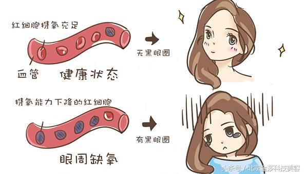 常年黑眼圈怎么回事?拒绝熊猫眼,击退黑眼圈!