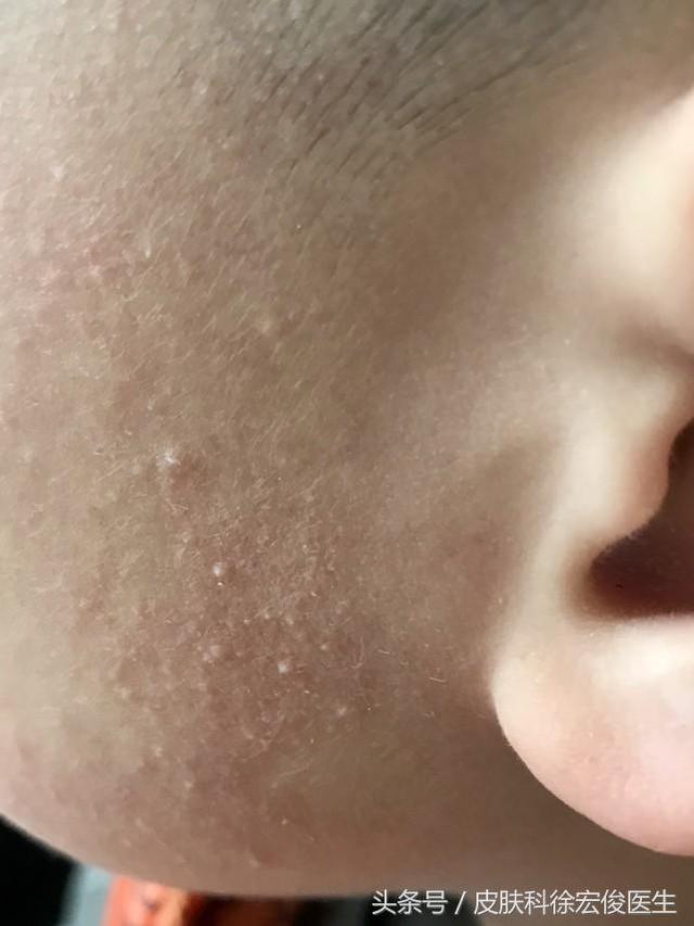 鸡皮肤太难看了,有什么好的办法可以根治吗?