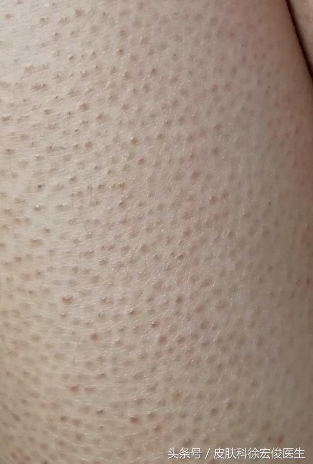 鸡皮肤太难看了,有什么好的办法可以根治吗?