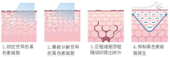 遗传性的雀斑能去掉吗,什么办法比较好?