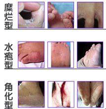����������Ƥ��Ѣ���ų������ݣ������Ч�����Ʒ���