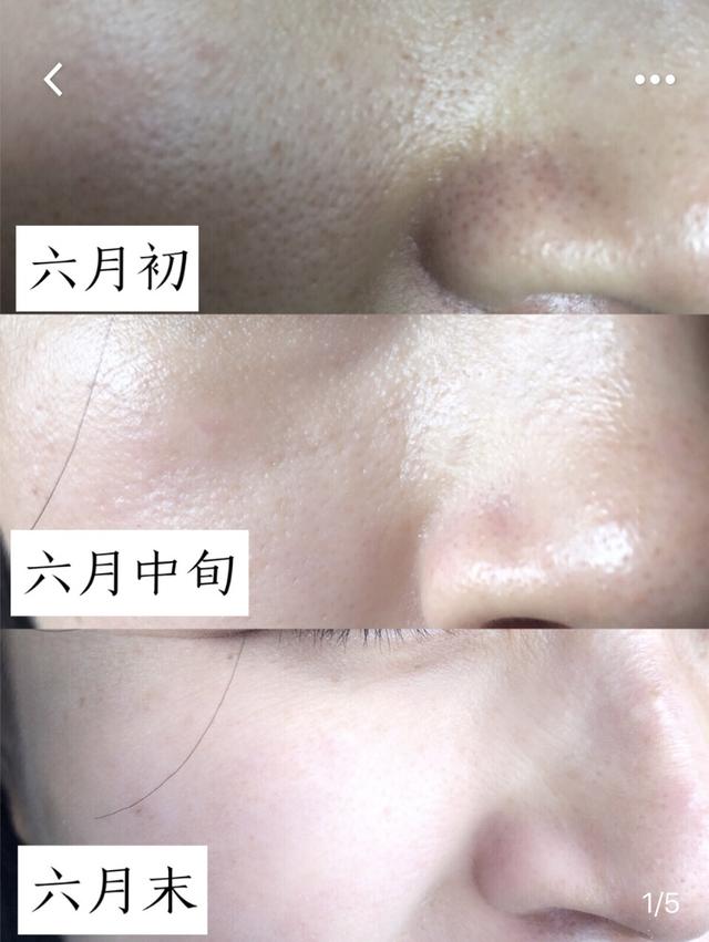 巧用白醋!30天解决毛孔粗大!大油皮逆袭分享