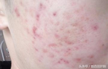 如何去除“痘坑、痘疤”