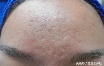 如何去除“痘坑、痘疤”
