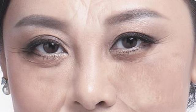 黑眼圈让人又老又难看,教您3个小妙招,轻松祛除黑眼圈和眼袋
