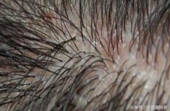 新成果:慢性脱发、脂溢性脱发根治方法推荐