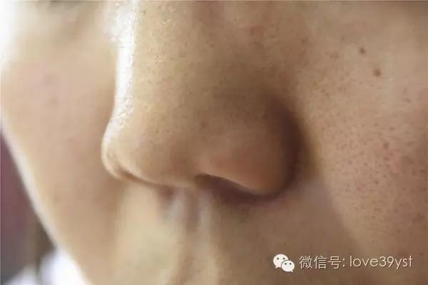 十人九痔 痔疮久拖不治 到底会有哪些危害呢