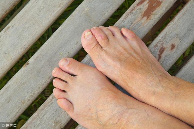 导致灰指甲产生的因素有很多,预防灰指甲的方法这里找