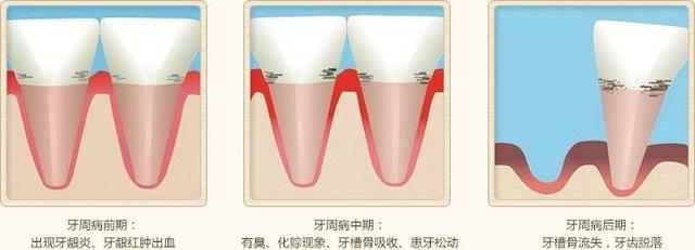 牙齿松动了怎么办?难道只能眼睁睁的看着它掉落?