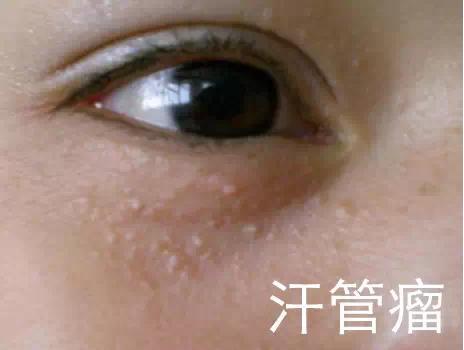 脸上长脂肪粒是怎么回事!改善脂肪粒,教你几招!