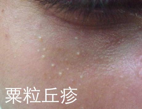 脸上长脂肪粒是怎么回事!改善脂肪粒,教你几招!