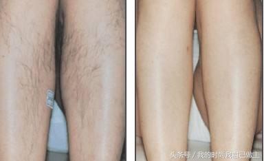 脱毛最持久又立马见效的方法,你还不试试?
