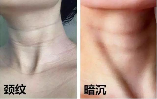 20岁就有颈纹?想要去掉颈纹只用颈霜做不到!
