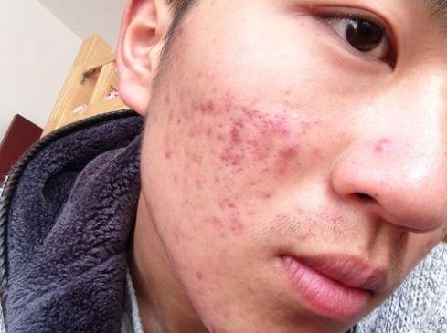脸上的痘痘和印痘坑去除方法