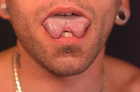 埃里克·斯普拉格,人称"蜥蜴人",生于1972年,是"分割舌头"整容术的